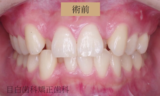 Case 04 叢生（でこぼこの歯）非抜歯の症例