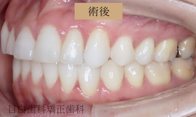 Case 04 叢生（でこぼこの歯）非抜歯の症例