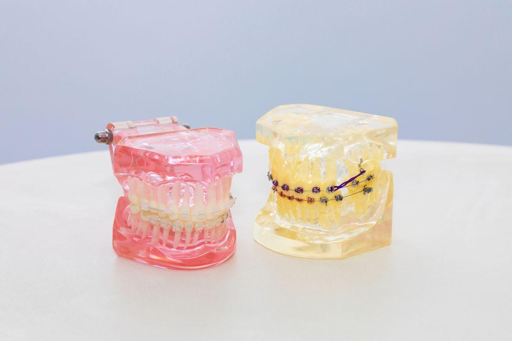 歯列矯正をする模型