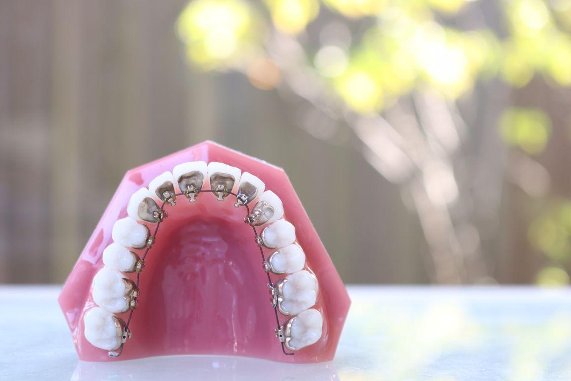 裏側矯正の歯の模型