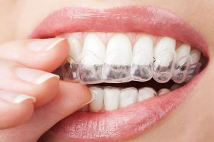 出っ歯のインビザライン治療③矯正スタート