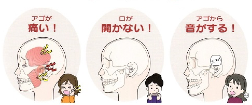 顎関節症の症状