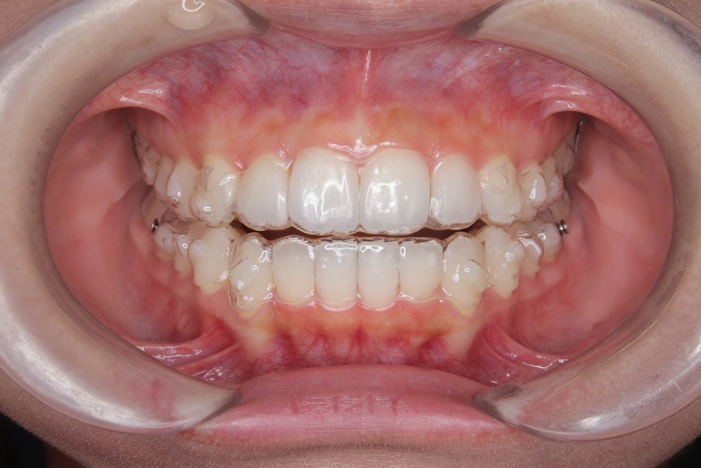 マウスピース矯正ブログ④