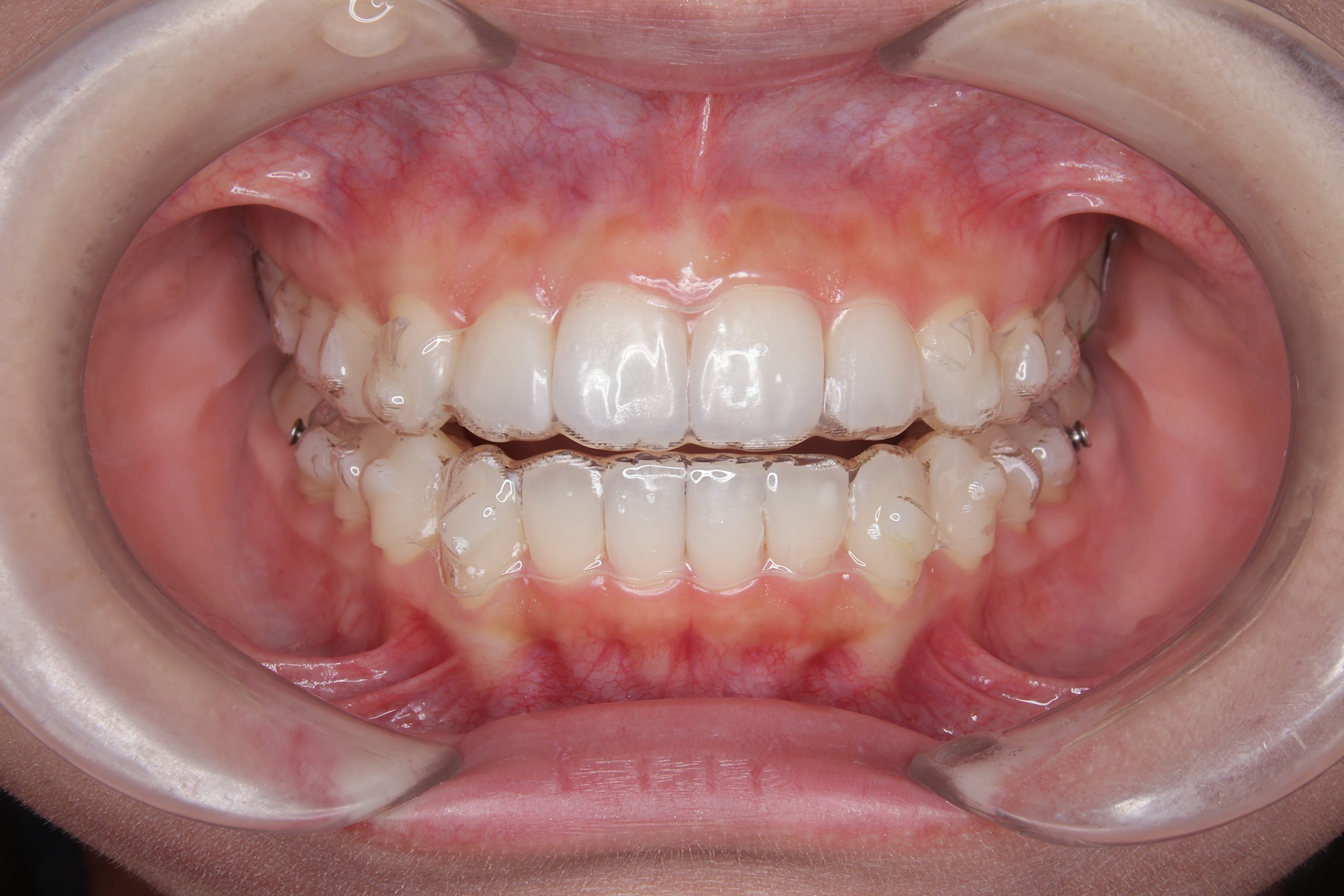 マウスピース矯正ブログ④