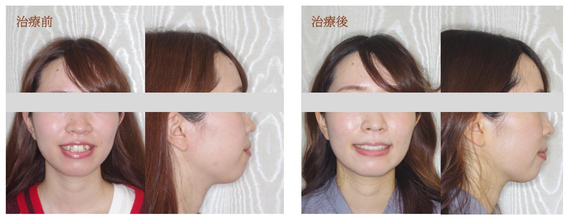 前歯のデコボコを治療した症例